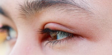 Cảnh giác với các biến chứng viêm bờ mi