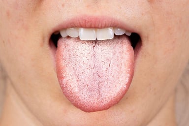 Nấm miệng: Nhận biết, điều trị và phòng ngừa tái phát