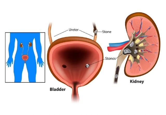 Siêu âm sỏi bàng quang &#8211; Cách sử dụng để chẩn đoán sỏi