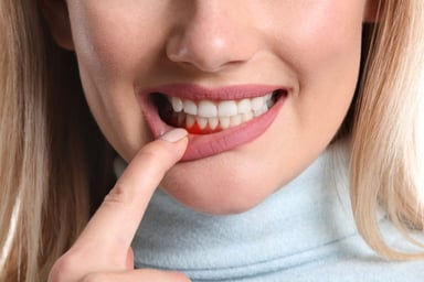 Chuyên gia giải đáp: Viêm chân răng làm sao hết?