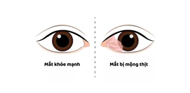 Bệnh mộng thịt ở mắt: Nguyên nhân, dấu hiệu, cách điều trị