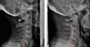 Vôi hóa đốt sống cổ: Nguyên nhân và cách điều trị hiệu quả