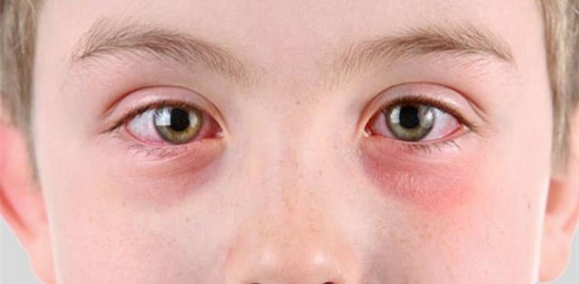Đau mắt đỏ ở trẻ sơ sinh &#8211; Nguyên nhân do đâu?