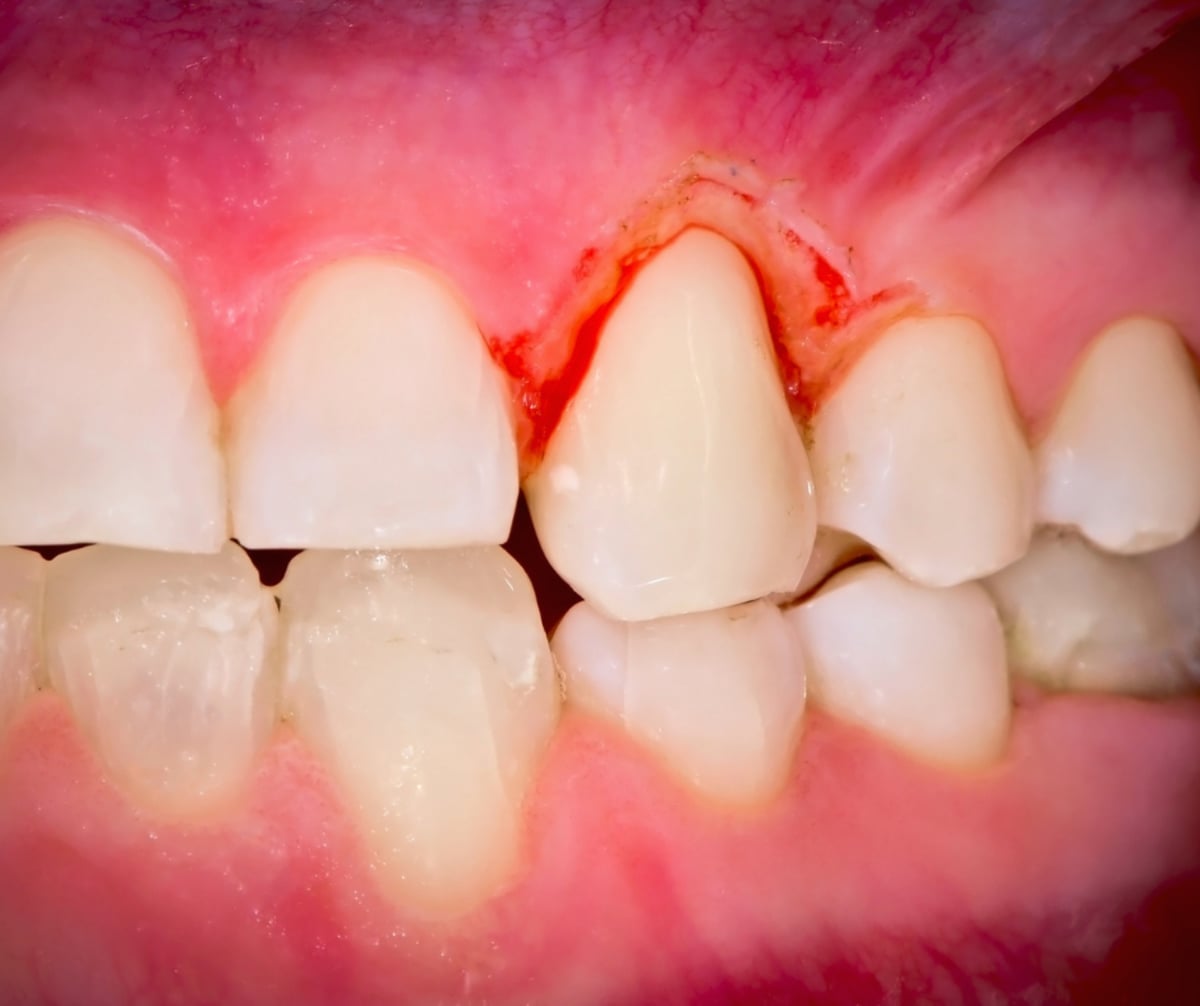 Điều trị viêm nướu cho từng giai đoạn