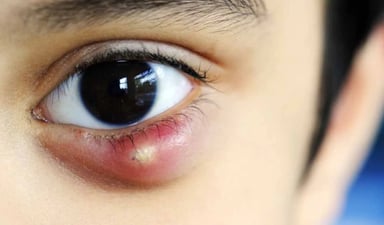 Nhận biết mắt lên chắp và cách điều trị triệt để