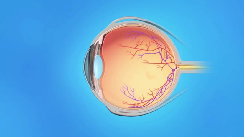 Phân biệt các bệnh lý dịch kính võng mạc