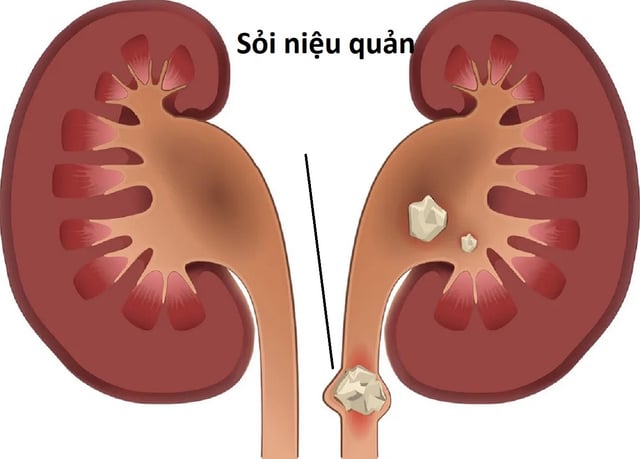 Giải đáp: Sỏi niệu quản có tán được không?