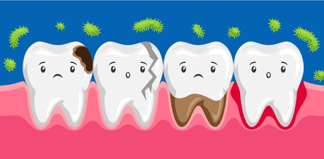 Các phương pháp trị sâu răng vĩnh viễn, hiệu quả cao