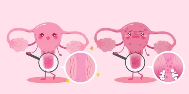Viêm âm đạo do tạp khuẩn ở nữ giới và cách điều trị