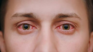 Viêm kết mạc là gì? Nguyên nhân, triệu chứng, cách điều trị