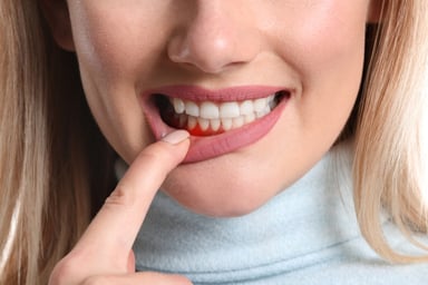 Nguyên nhân bị viêm lợi và cách điều trị