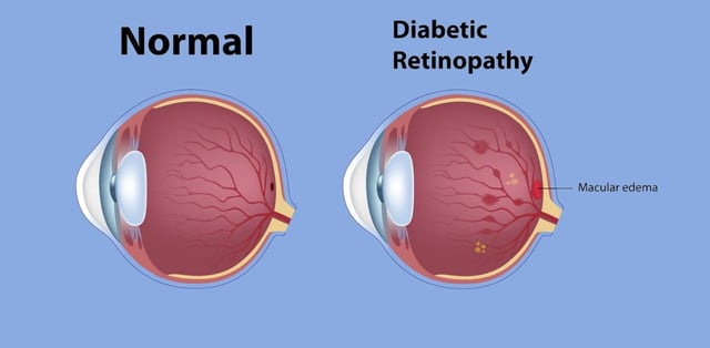 Bệnh phù hoàng điểm là gì, có nguy hiểm không?