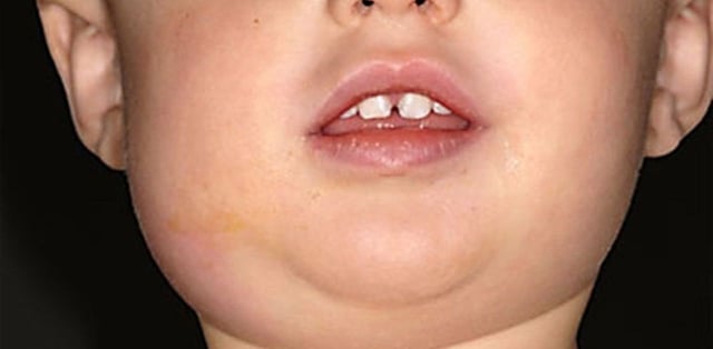 Bệnh quai bị uống thuốc gì?