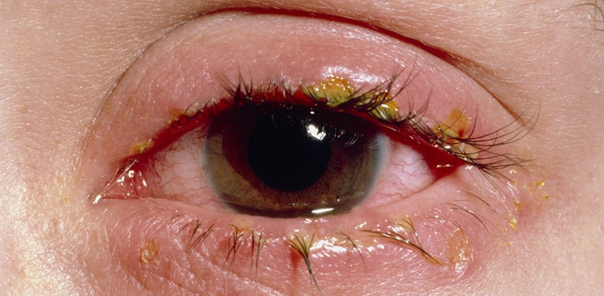 Điều trị bệnh viêm kết mạc mãn tính như thế nào?