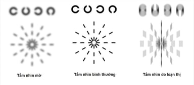 Những điều cần biết về loạn thị một mắt, loạn thị hai mắt