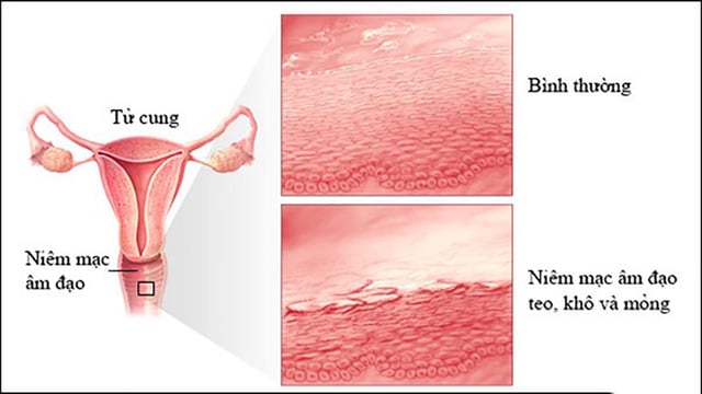 Viêm teo âm đạo, bệnh phụ khoa ám ảnh với phụ nữ tiền mãn kinh