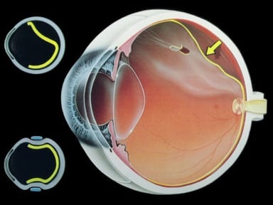 Võng mạc thoái hóa, căn bệnh nguy hiểm đối với mắt