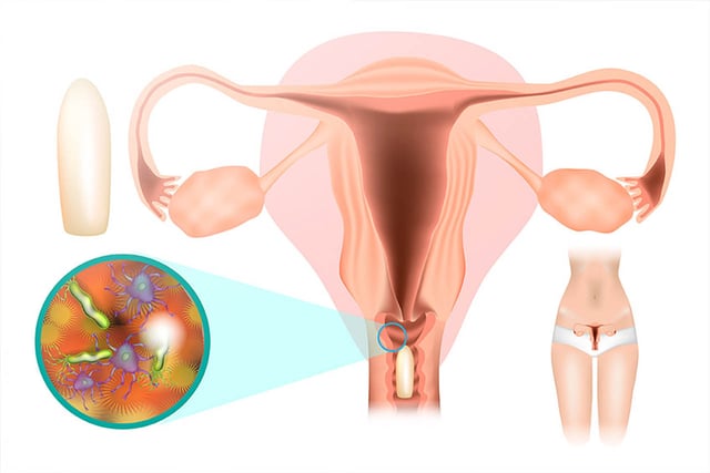 Nhận biết biểu hiện của nấm âm đạo để trị viêm âm đạo tốt hơn