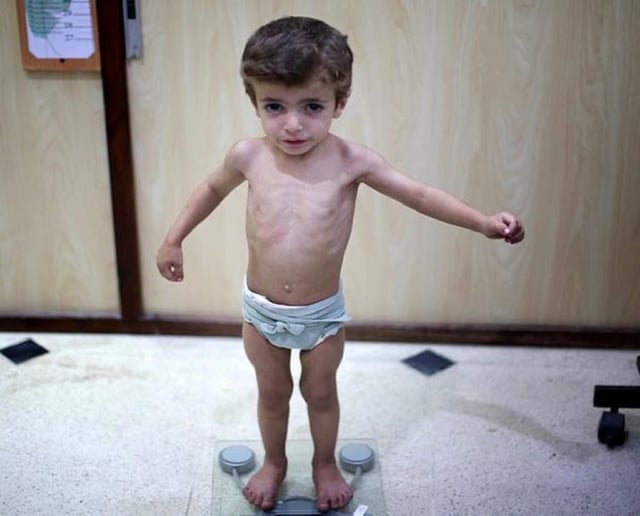 Cha mẹ chớ coi thường còi xương ở trẻ em