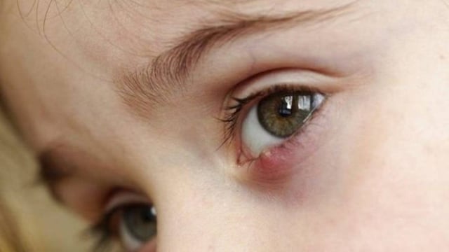 Những mẹo chữa chắp mắt mà có thể bạn chưa biết