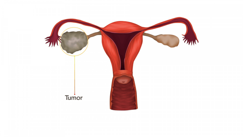 Tìm hiểu phác đồ điều trị ung thư buồng trứng