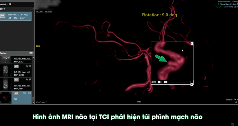 Phình mạch máu não &#8211; Bệnh gây đau đầu chóng mặt kéo dài
