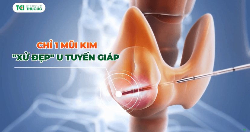 Chỉ 1 mũi kim &#8211; &#8220;xử đẹp&#8221; u tuyến giáp