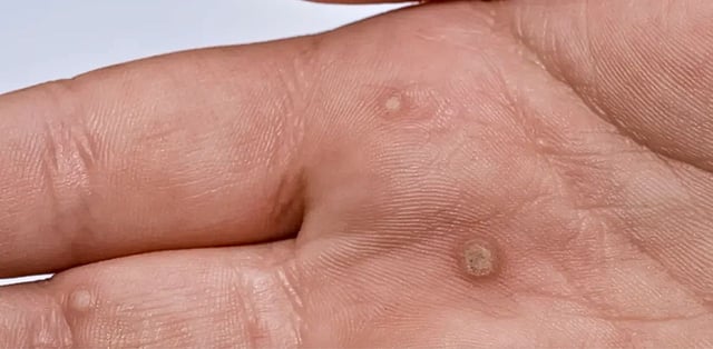 Các đường lây bệnh sùi mào gà và cách phòng tránh