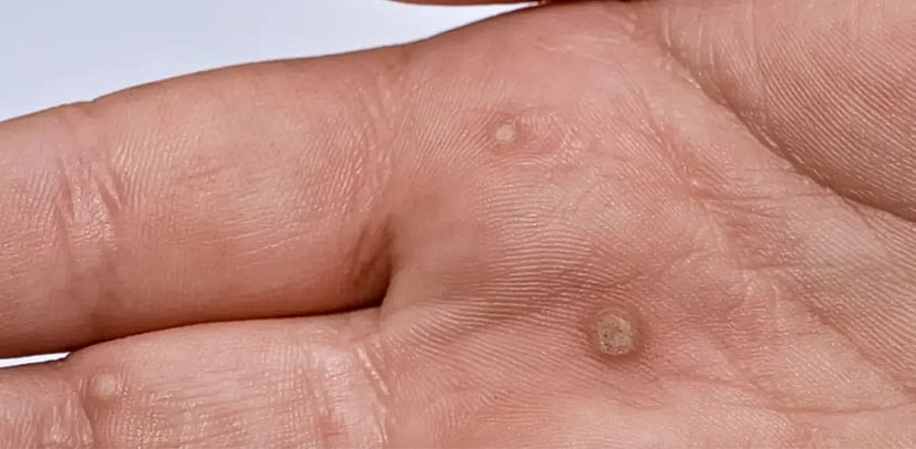 Các đường lây bệnh sùi mào gà và cách phòng tránh
