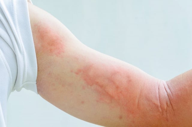 Bị dị ứng có được tiêm vacxin hay không?