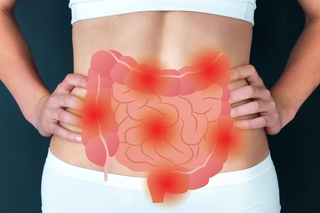 Điều trị viêm ruột &#8211; bệnh lý đường tiêu hóa nguy hiểm