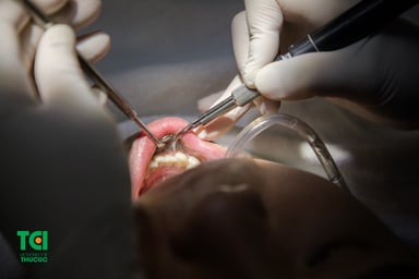 Lấy cao răng tại nhà đơn giản với 5 cách