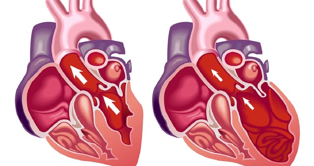 Nguyên nhân suy tim phải và hậu quả khó lường