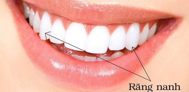 Răng nanh và những lưu ý sau khi nhổ răng nanh?