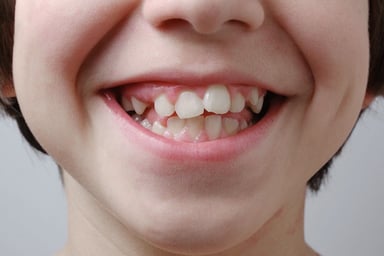 Răng lệch khớp cắn và những tác hại