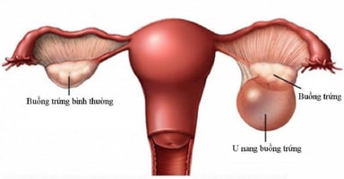 3 cách trị bệnh u nang buồng trứng hiệu quả, phổ biến hiện nay