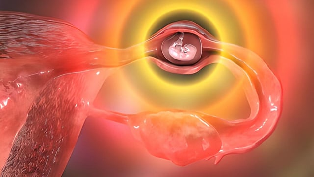 Nguyên nhân có thai ngoài tử cung là gì? Xử trí như thế nào?