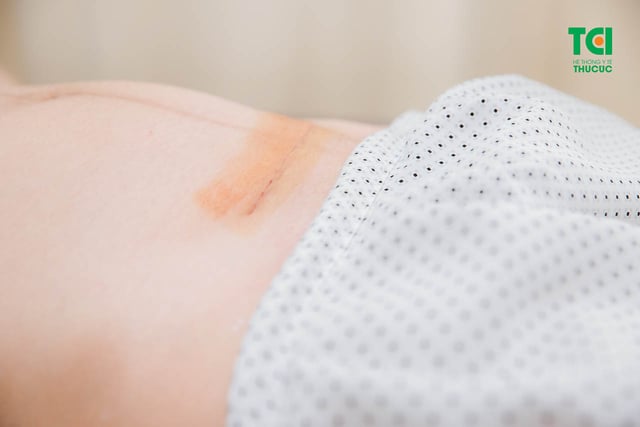 Sau đẻ mổ 4 tháng lại có bầu phải làm sao?