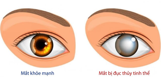 Điều trị bệnh lý đục thủy tinh thể ở người tiểu đường như thế nào?