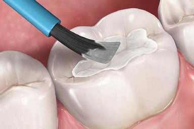 Những điều cần lưu ý về chăm sóc sau hàn răng sâu
