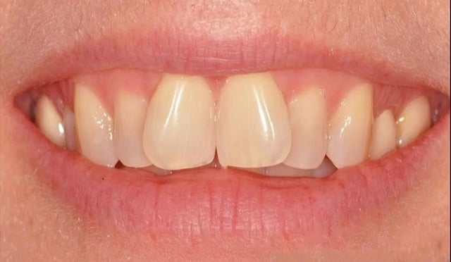 Nguyên nhân răng cửa mọc lệch và cách khắc phục