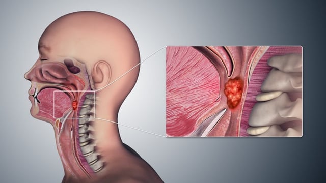 Biểu hiện ung thư vòm họng phổ biến cần biết