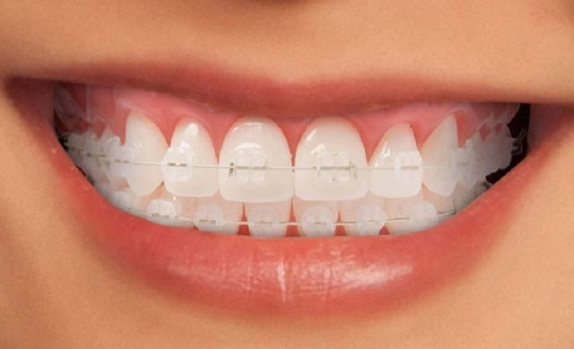 Niềng răng mắc cài sứ và những điều cần biết