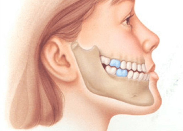 Tình trạng răng móm và cách điều trị