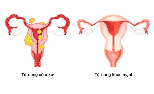 Thắc mắc u xơ tử cung tự rụng được không?