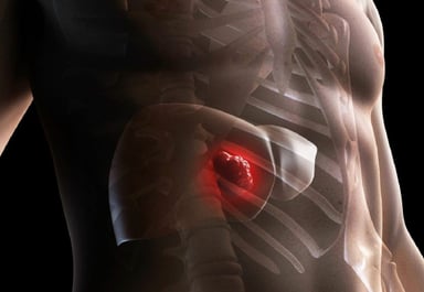 Tìm hiểu về các dấu hiệu ung thư gan giai đoạn cuối
