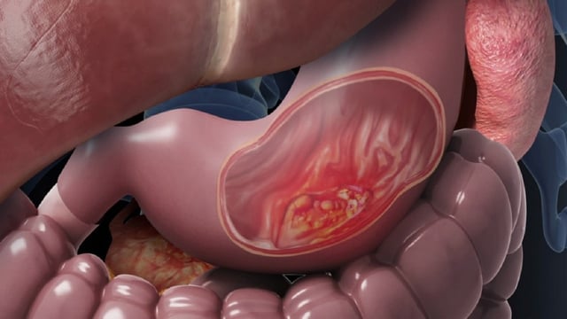 Ung thư dạ dày giai đoạn 4 &#8211; Tiên lượng và điều trị