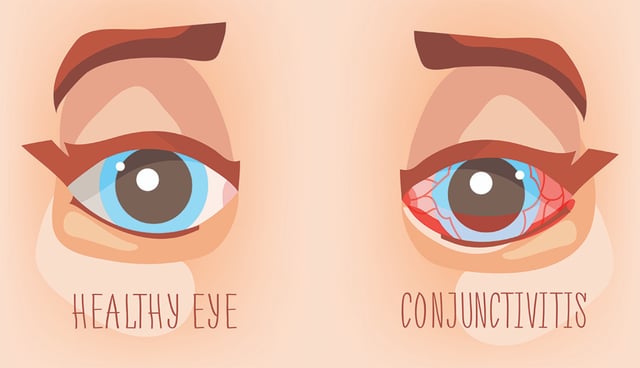 Điều trị viêm màng bồ đào: Thông tin cơ bản