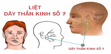 Liệt dây 7 trung ương để lại di chứng nặng nề