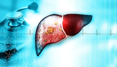 Các phương pháp điển hình trong điều trị ung thư gan